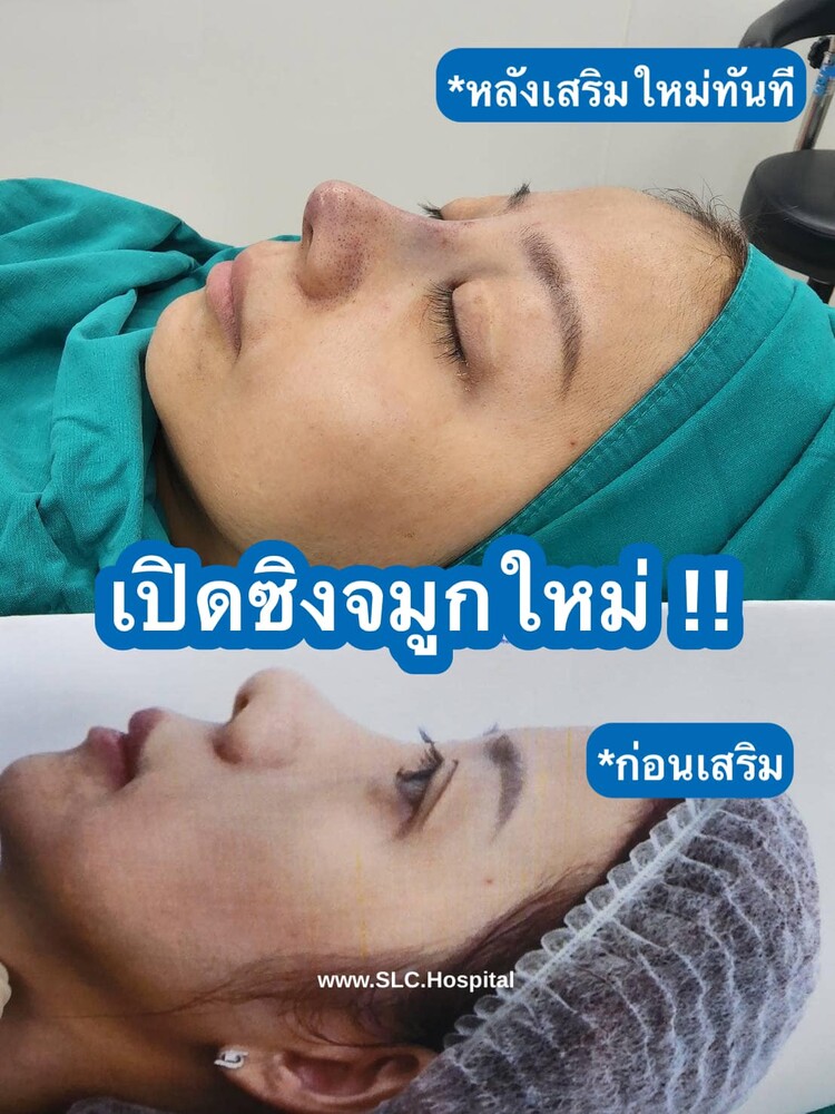 Before and After Result